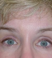 brow-lift-1-after-109-1
