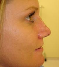 rhinoplasty-1-after-right-side-119